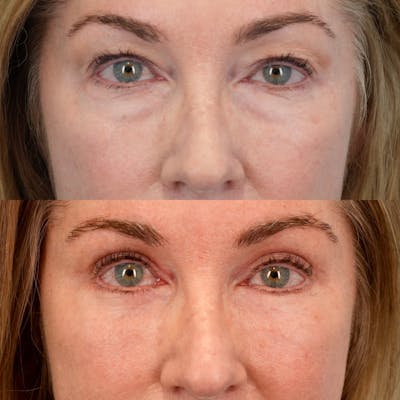 Lower Eyelids Before & After Gallery - Patient 547279 - Image 1