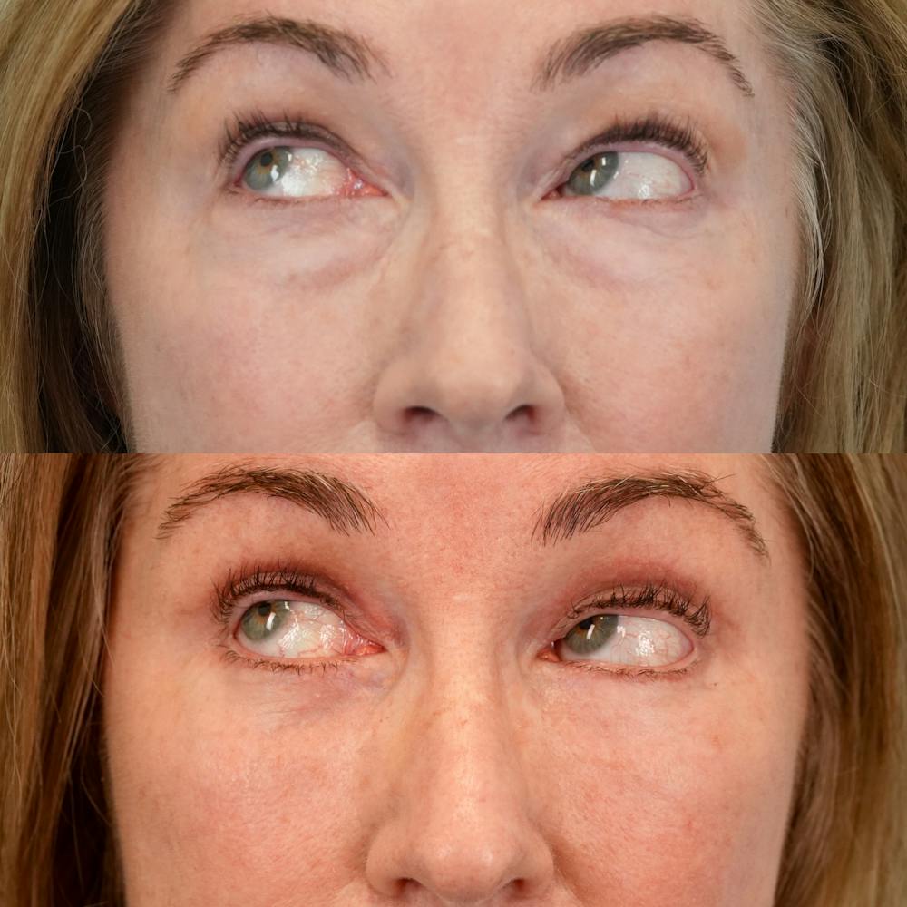 Lower Eyelids Before & After Gallery - Patient 547279 - Image 5