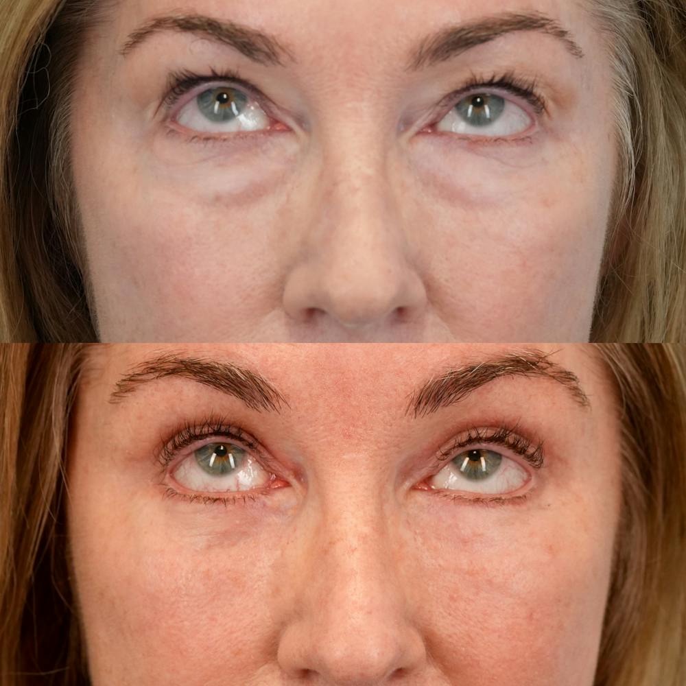 Lower Eyelids Before & After Gallery - Patient 547279 - Image 2