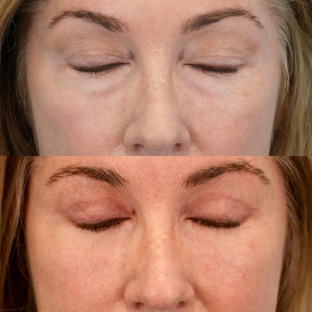 Lower Eyelids Before & After Gallery - Patient 547279 - Image 3