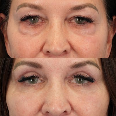Lower Eyelids Before & After Gallery - Patient 576792 - Image 1