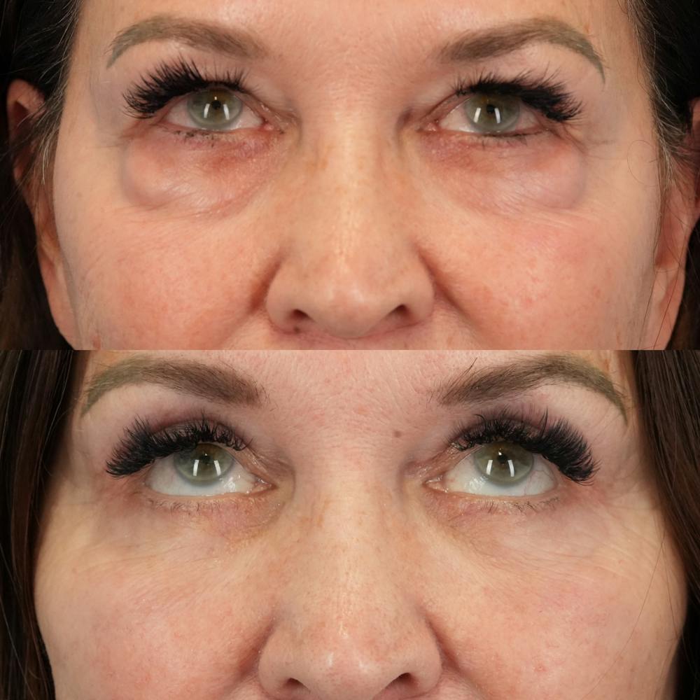 Lower Eyelids Before & After Gallery - Patient 576792 - Image 2