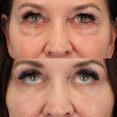 Lower Eyelids Before & After Gallery - Patient 576792 - Image 2