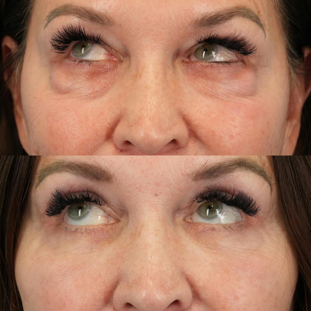 Lower Eyelids Before & After Gallery - Patient 576792 - Image 5