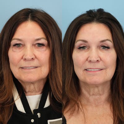 Lower Eyelids Before & After Gallery - Patient 576792 - Image 6