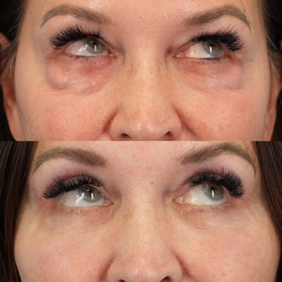 Lower Eyelids Before & After Gallery - Patient 576792 - Image 4