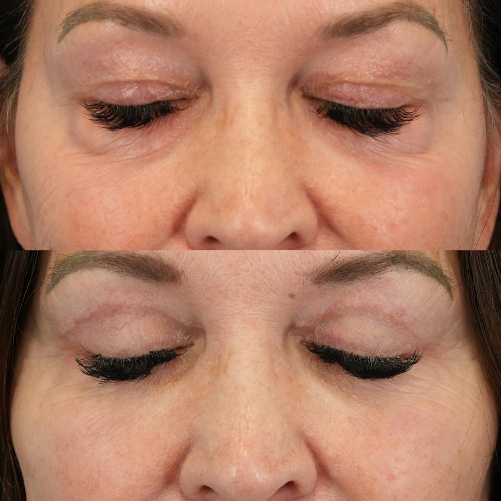 Lower Eyelids Before & After Gallery - Patient 576792 - Image 3