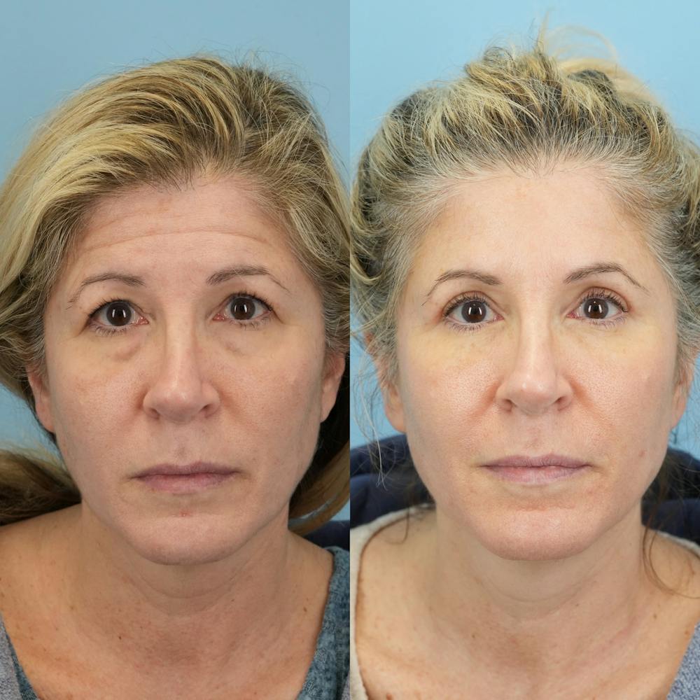 Lower Eyelids Before & After Gallery - Patient 150057 - Image 6