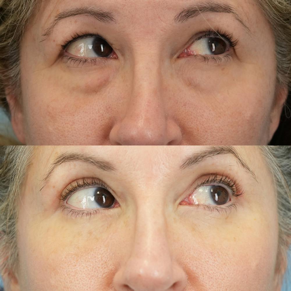 Lower Eyelids Before & After Gallery - Patient 150057 - Image 4