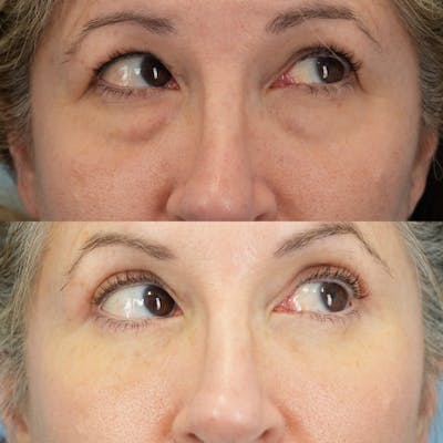 Lower Eyelids Before & After Gallery - Patient 150057 - Image 4