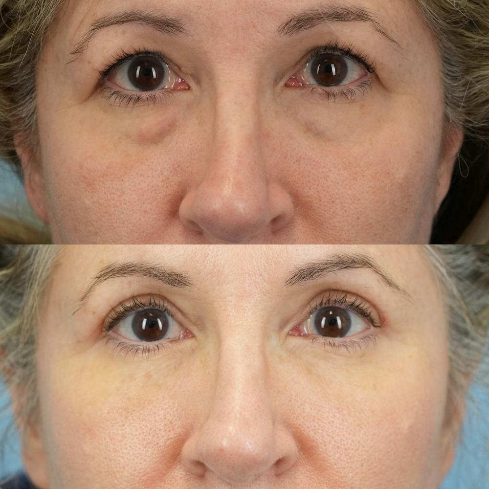 Lower Eyelids Before & After Gallery - Patient 150057 - Image 1