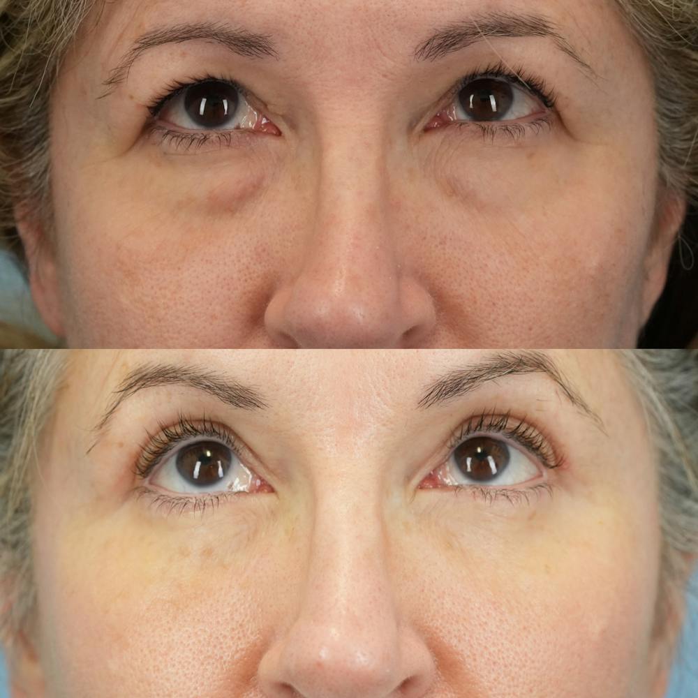 Lower Eyelids Before & After Gallery - Patient 150057 - Image 2