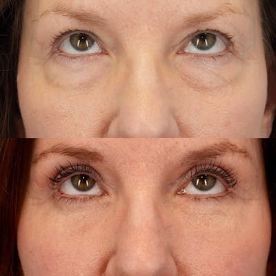 Lower Eyelids Before & After Gallery - Patient 269023 - Image 2