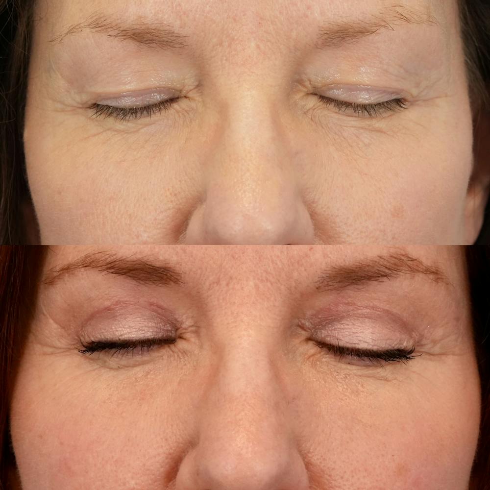 Lower Eyelids Before & After Gallery - Patient 269023 - Image 3