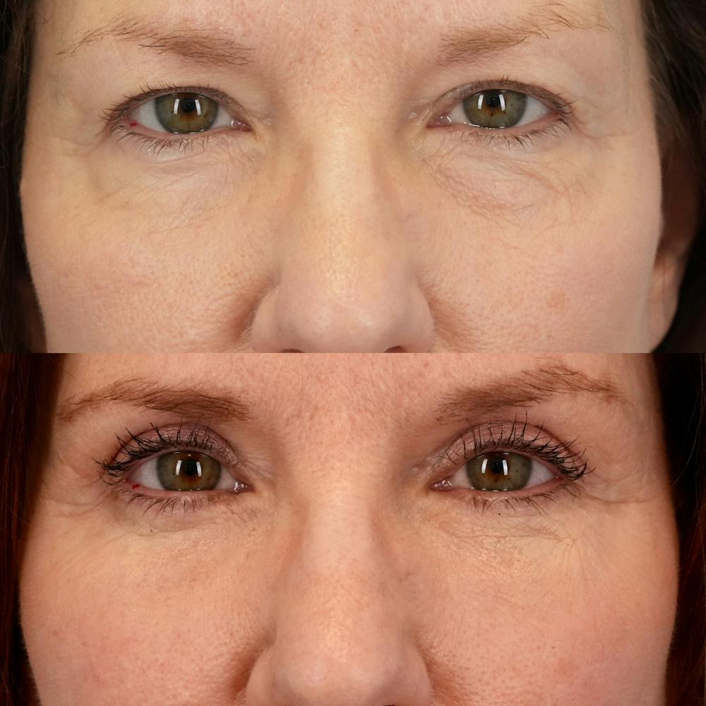 Lower Eyelids Before & After Gallery - Patient 269023 - Image 1