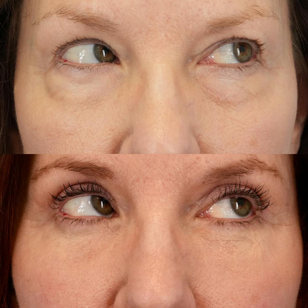 Lower Eyelids Before & After Gallery - Patient 269023 - Image 4