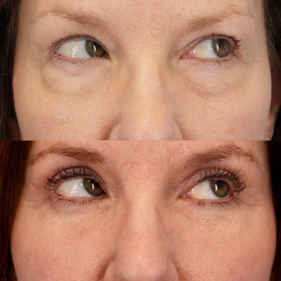 Lower Eyelids Before & After Gallery - Patient 269023 - Image 4