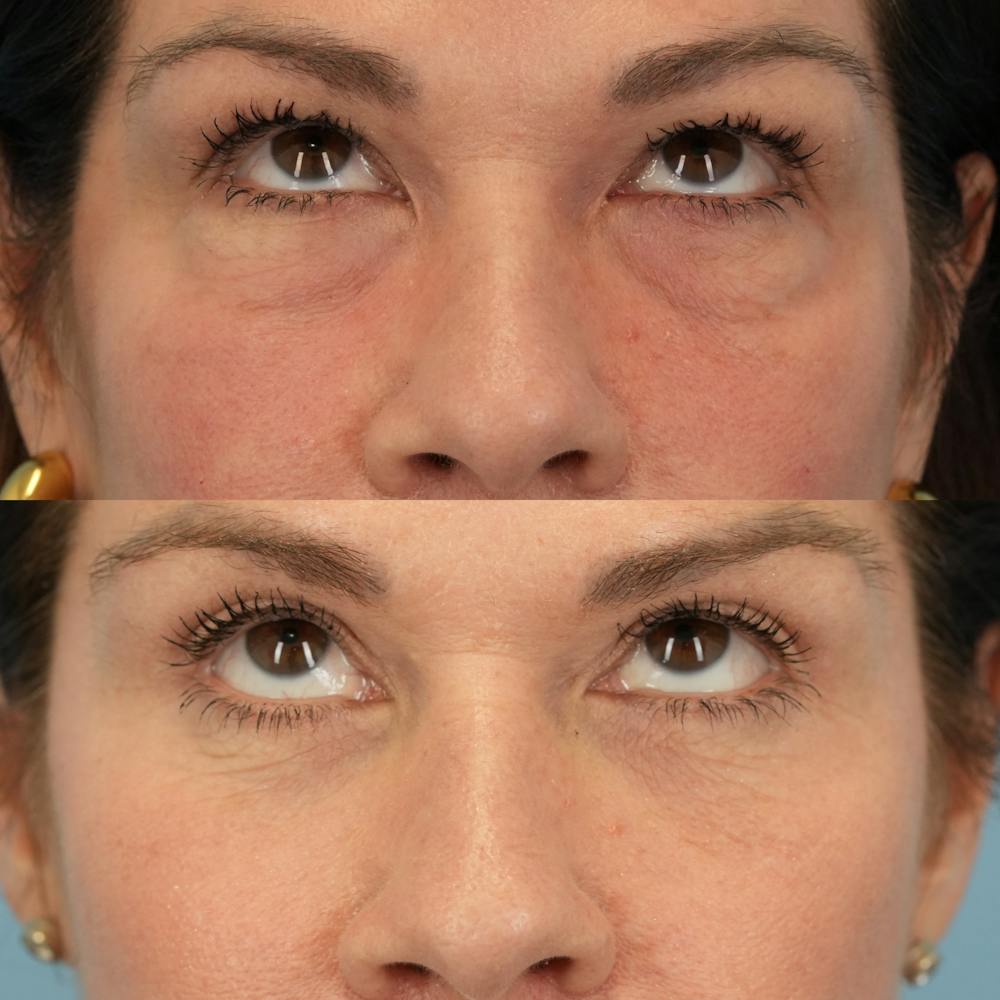 Lower Eyelids Before & After Gallery - Patient 161231 - Image 2
