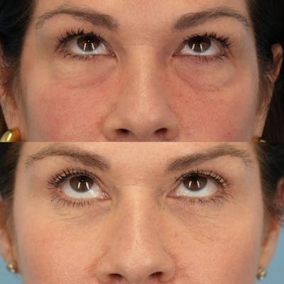Lower Eyelids Before & After Gallery - Patient 161231 - Image 2