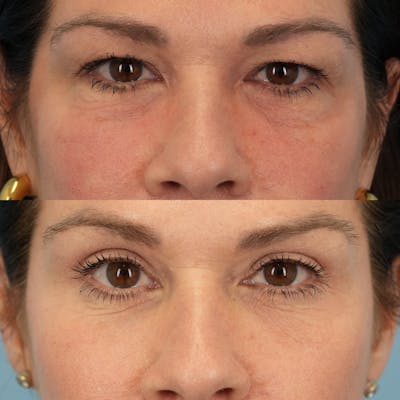 Lower Eyelids Before & After Gallery - Patient 161231 - Image 1