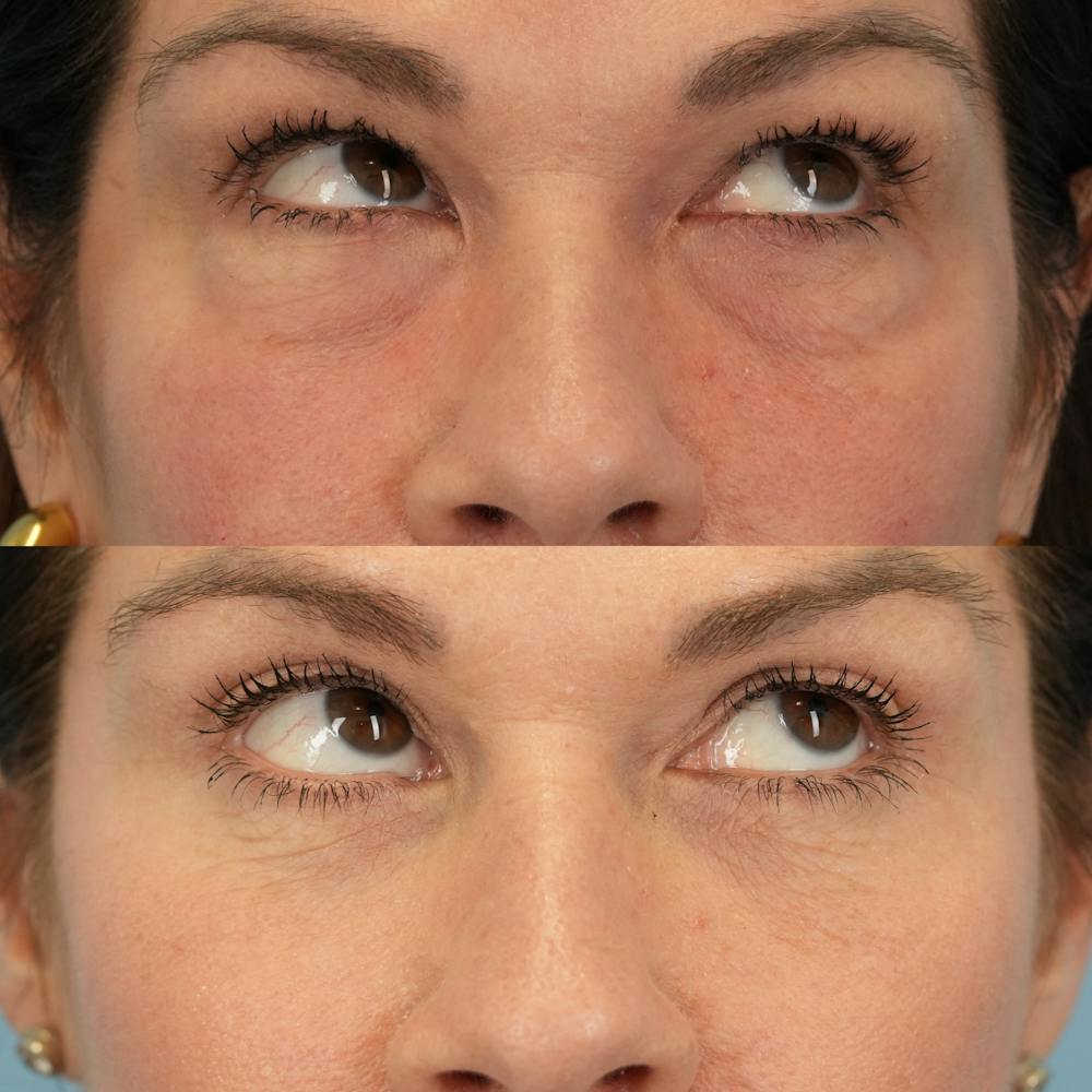 Lower Eyelids Before & After Gallery - Patient 161231 - Image 4