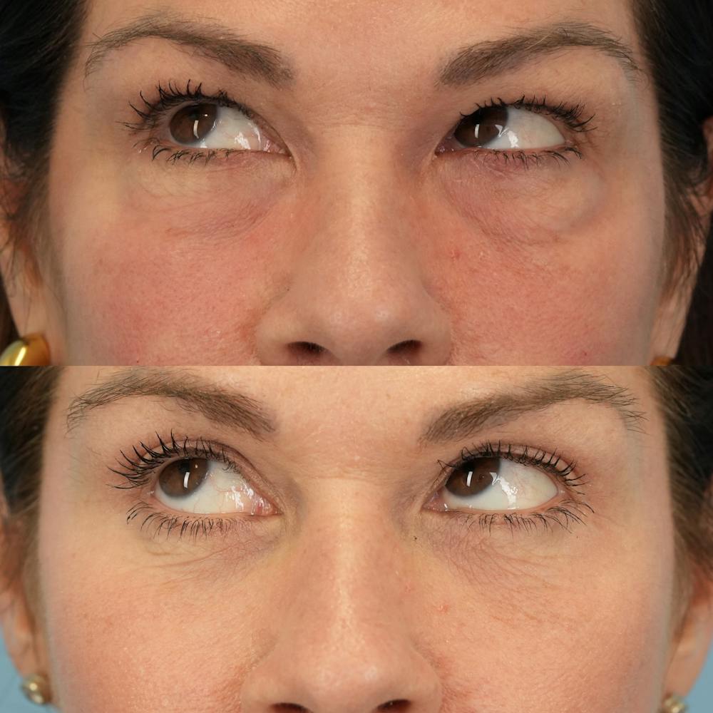 Lower Eyelids Before & After Gallery - Patient 161231 - Image 5