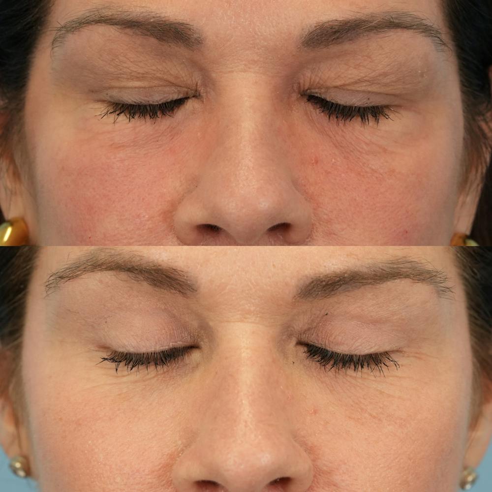 Lower Eyelids Before & After Gallery - Patient 161231 - Image 3