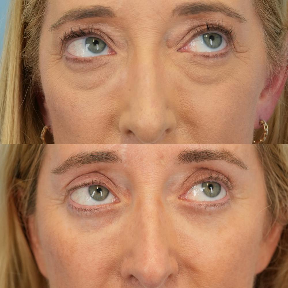 Lower Eyelids Before & After Gallery - Patient 169041 - Image 4
