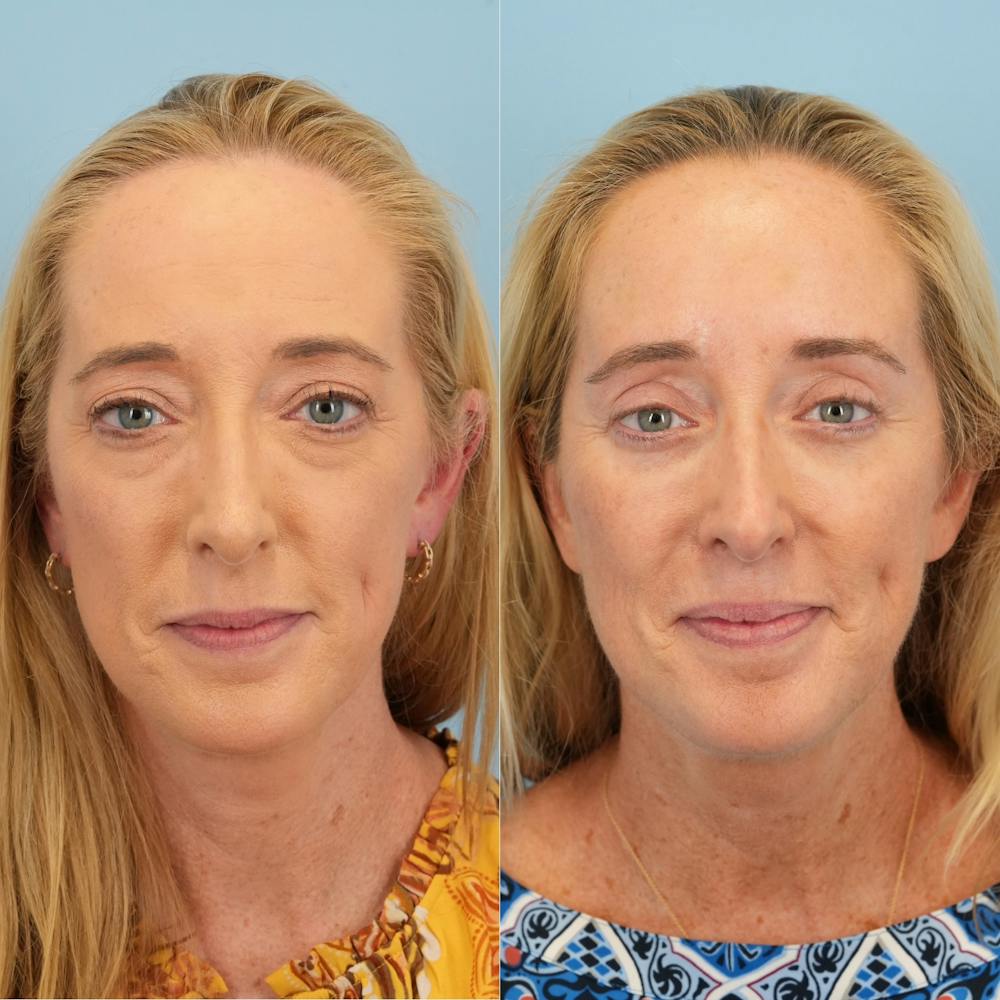 Lower Eyelids Before & After Gallery - Patient 169041 - Image 6