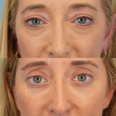 Lower Eyelids Before & After Gallery - Patient 169041 - Image 1