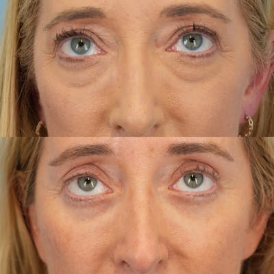 Lower Eyelids Before & After Gallery - Patient 169041 - Image 2