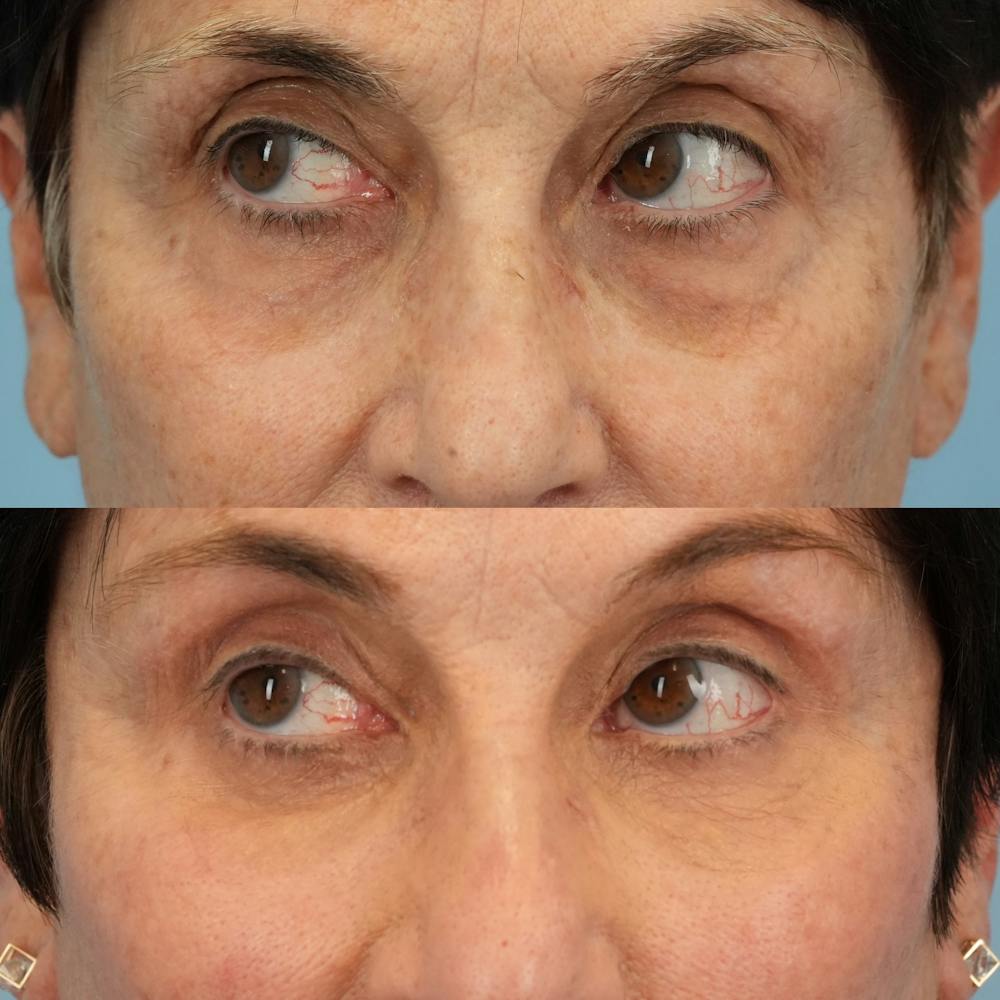 Lower Eyelids Before & After Gallery - Patient 307095 - Image 5
