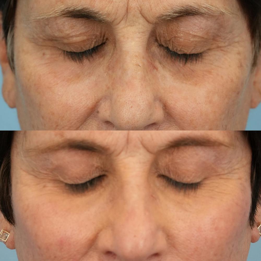 Lower Eyelids Before & After Gallery - Patient 307095 - Image 3