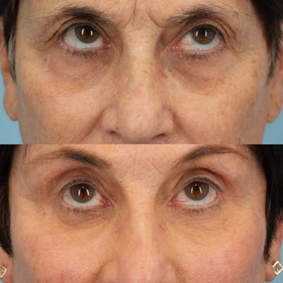 Lower Eyelids Before & After Gallery - Patient 307095 - Image 2