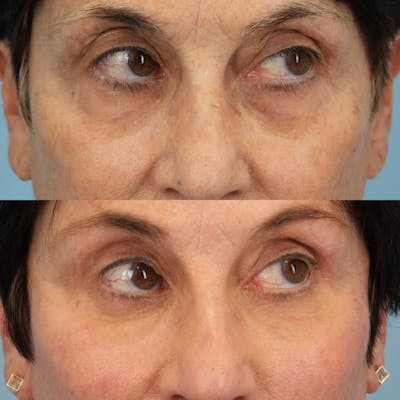 Lower Eyelids Before & After Gallery - Patient 307095 - Image 4