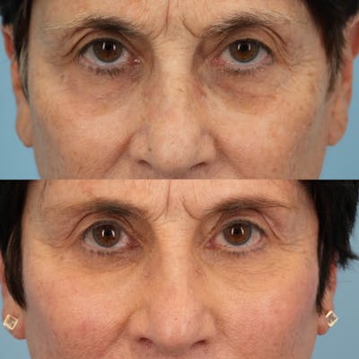 Lower Eyelids Before & After Gallery - Patient 307095 - Image 1