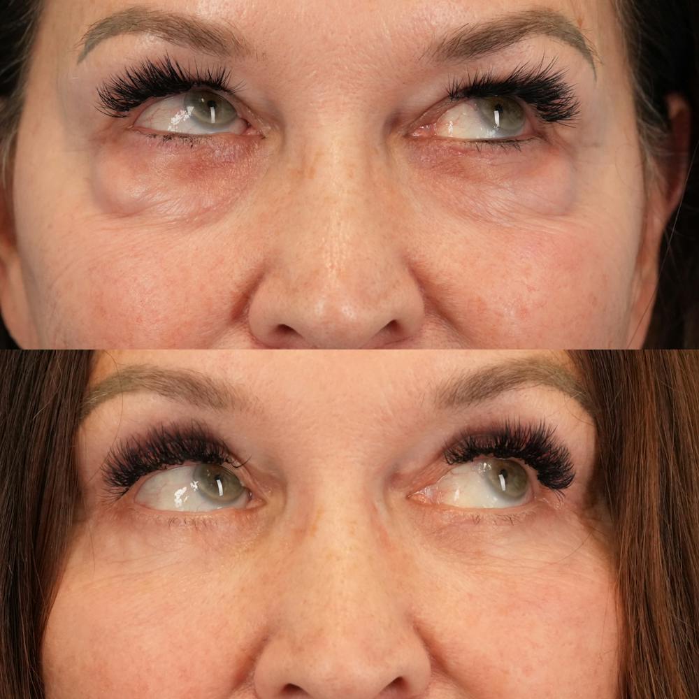 Lower Eyelids Before & After Gallery - Patient 338446 - Image 4