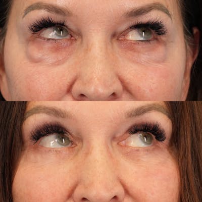 Lower Eyelids Before & After Gallery - Patient 338446 - Image 4