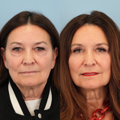 Lower Eyelids Before & After Gallery - Patient 338446 - Image 6