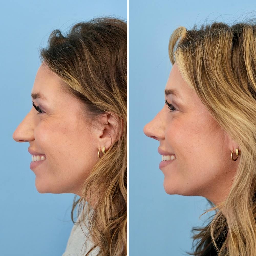 Rhinoplasty Before & After Gallery - Patient 317977 - Image 9