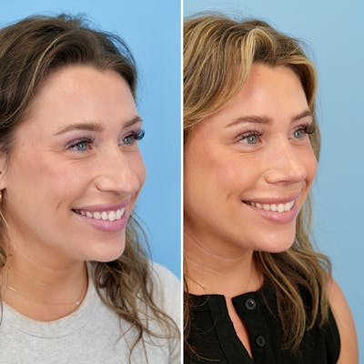 Rhinoplasty Before & After Gallery - Patient 317977 - Image 4