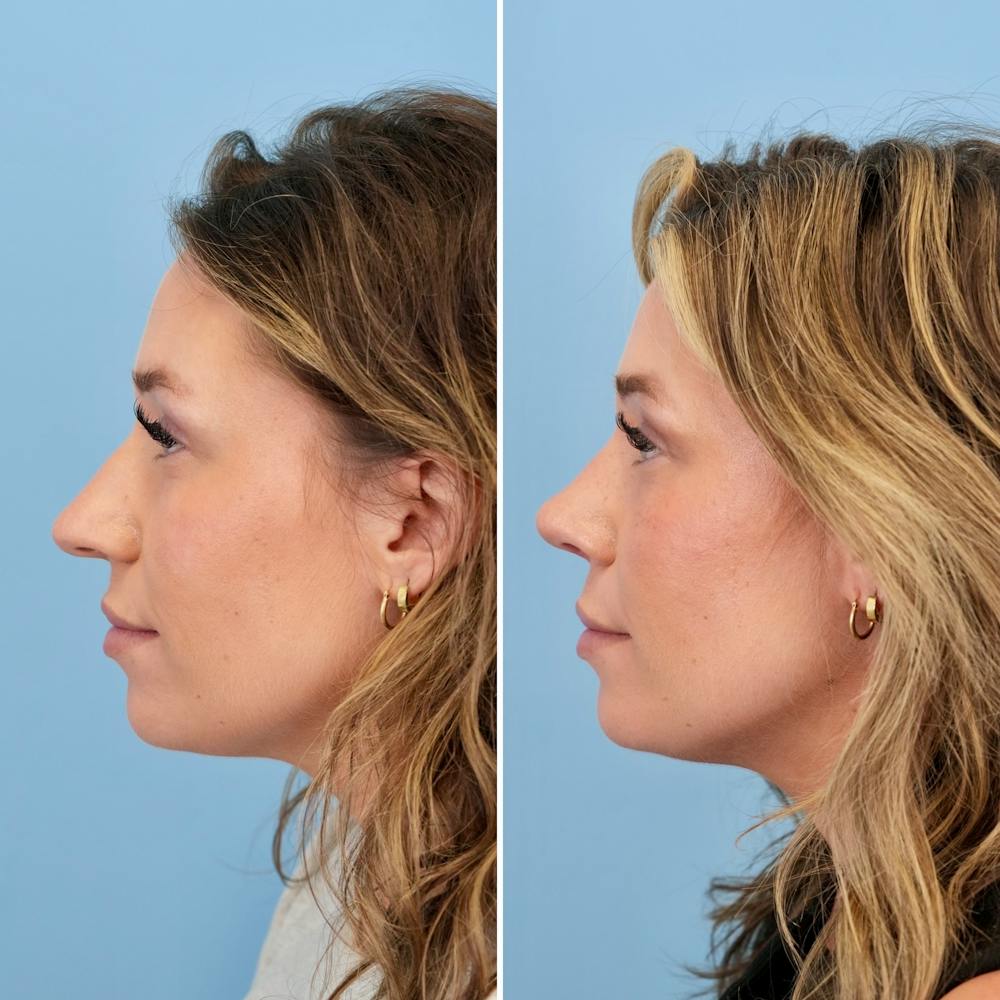 Rhinoplasty Before & After Gallery - Patient 317977 - Image 8
