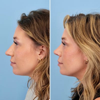 Rhinoplasty Before & After Gallery - Patient 317977 - Image 8