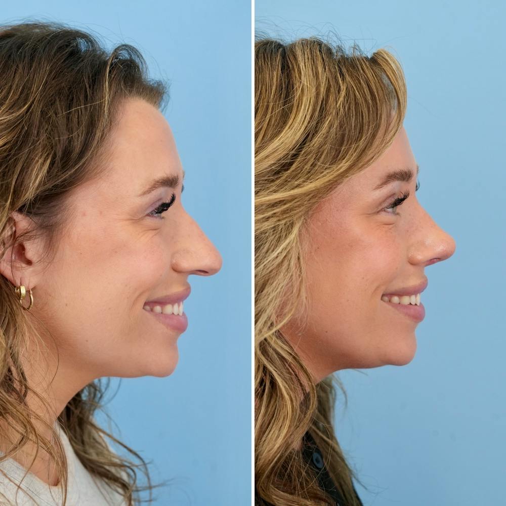 Rhinoplasty Before & After Gallery - Patient 317977 - Image 2