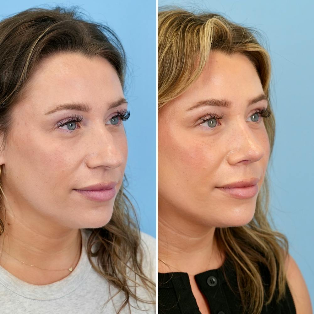 Rhinoplasty Before & After Gallery - Patient 317977 - Image 3