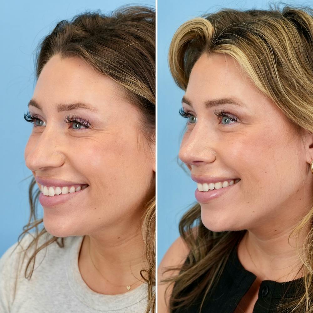 Rhinoplasty Before & After Gallery - Patient 317977 - Image 7