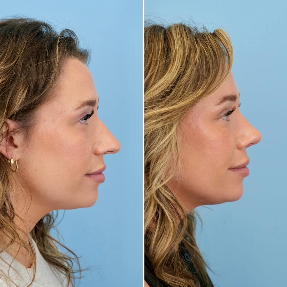 Rhinoplasty Before & After Gallery - Patient 317977 - Image 1