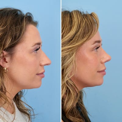 Rhinoplasty Before & After Gallery - Patient 317977 - Image 1