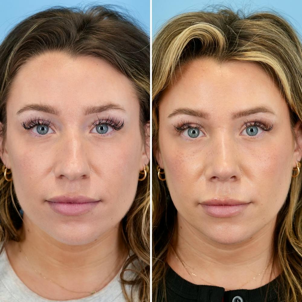 Rhinoplasty Before & After Gallery - Patient 317977 - Image 5