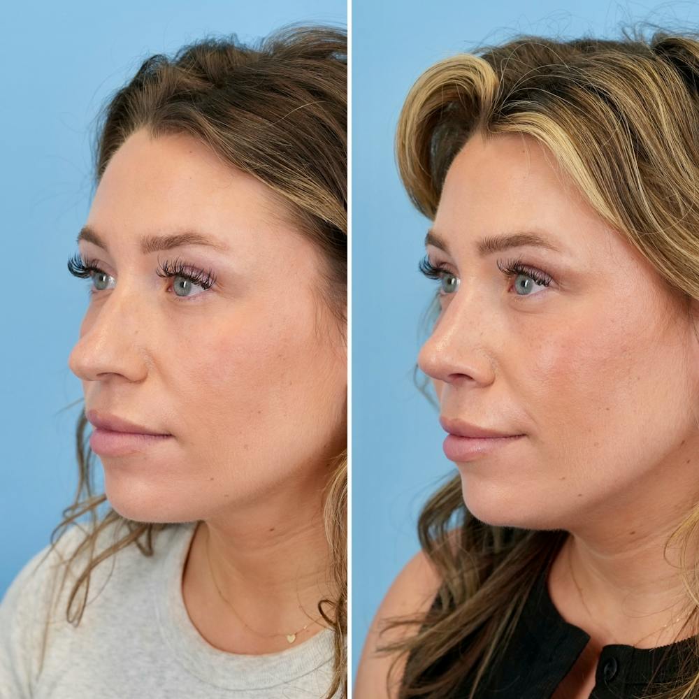 Rhinoplasty Before & After Gallery - Patient 317977 - Image 6